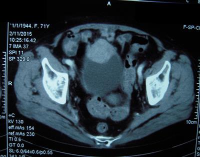 Case Report: Primary low-grade dedifferentiated liposarcoma of the urinary bladder with molecular confirmation